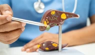 Defne yaprağı karaciğer dostu çıktı: NAFLD tedavisinde doğal umut