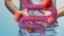 Antibiyotik kullanan nasıl beslenmeli? İşte bağırsakları onaran 7 gıda!