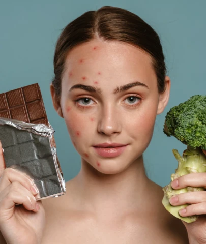 Diyet sivilceyi geçirir mi?